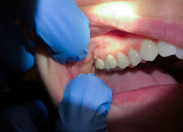 Best Dentist for Tooth Abscess  in Mcdonald, PA